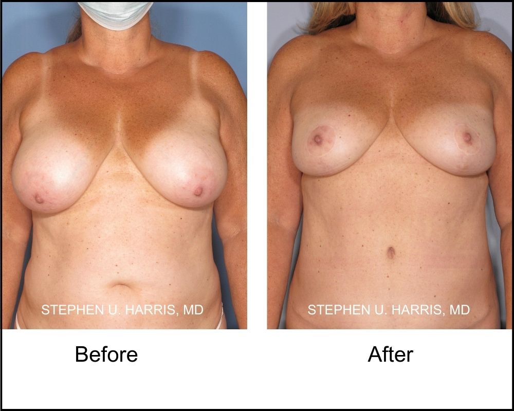 A front view of a pre-breast reduction surgery patient and after surgery.