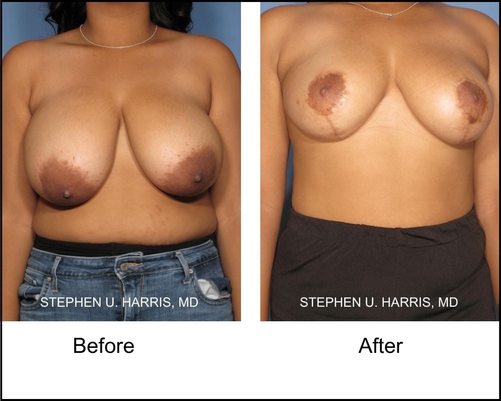 A before image, front shot, of a breast reduction patient and following surgery.