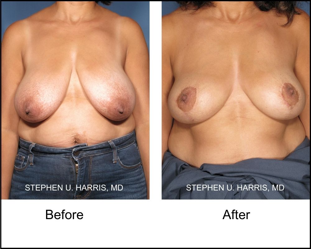 A front shot of a breast reduction surgery patient, pre-surgery and after surgery
